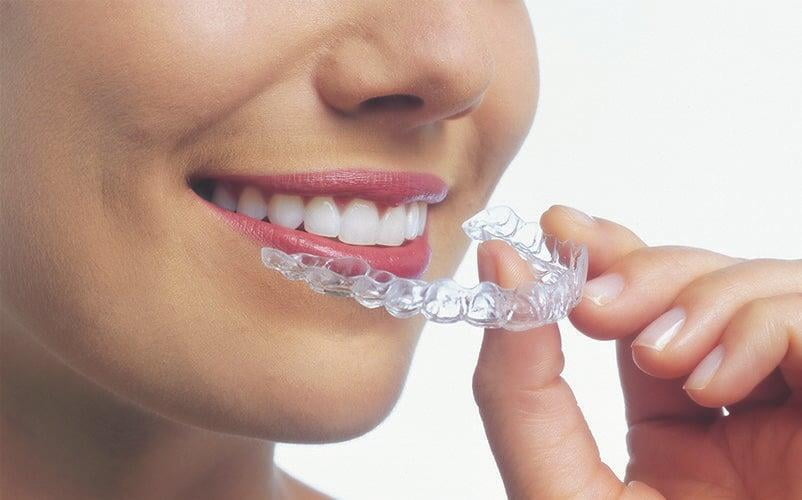 Clear aligner & Self Ligating Braces