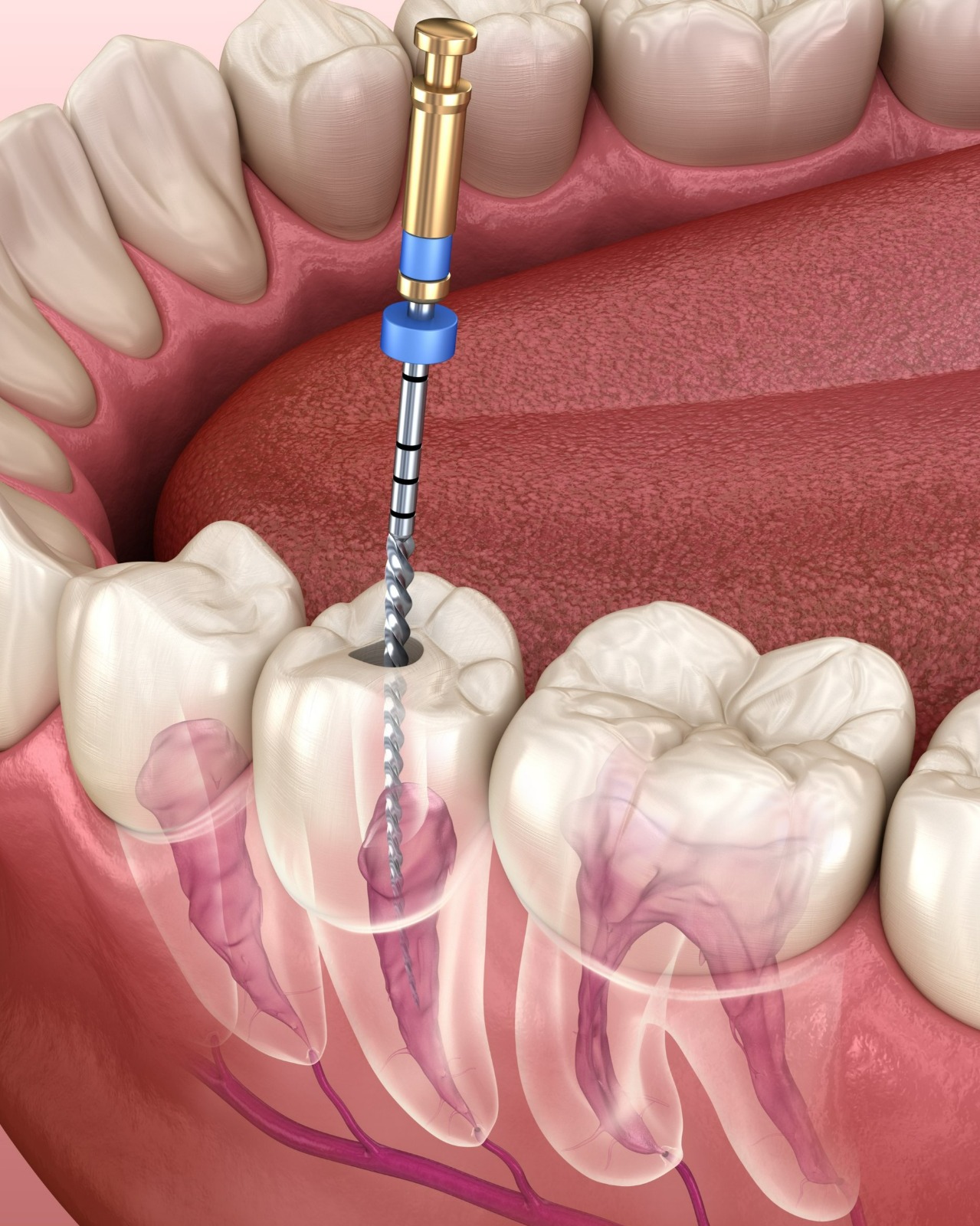 Root Canal Treatments