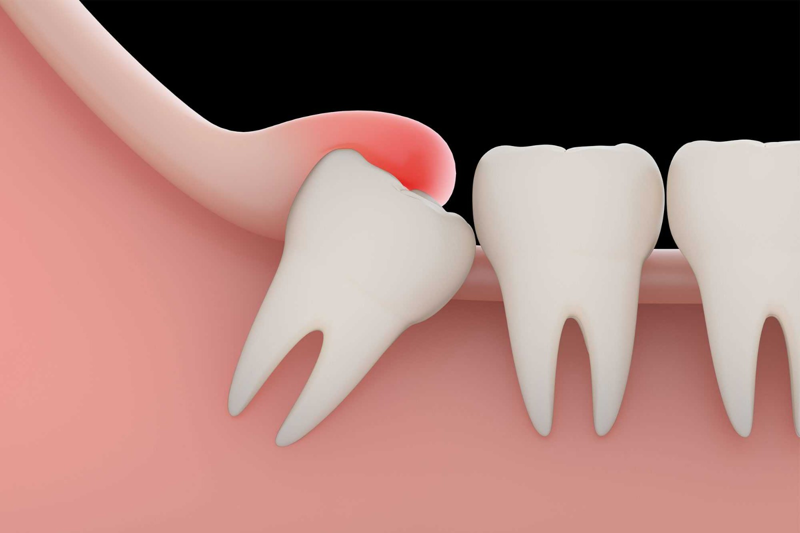 Teeth Extraction